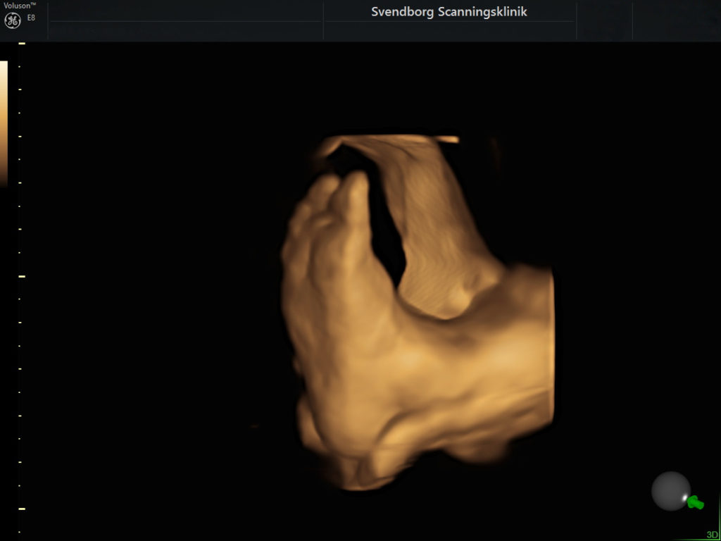 3D-scanning af fod